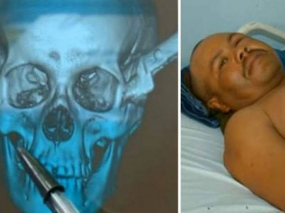 Brasileiro fica com faca encravada na cabeça e dirige por duas horas até chegar em hospital