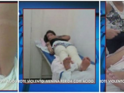 Jovem é queimada com ácido em trote 