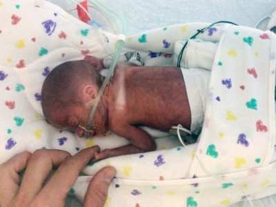 Bebê nasce prematuro com apenas 680 g durante cruzeiro e sobrevive 