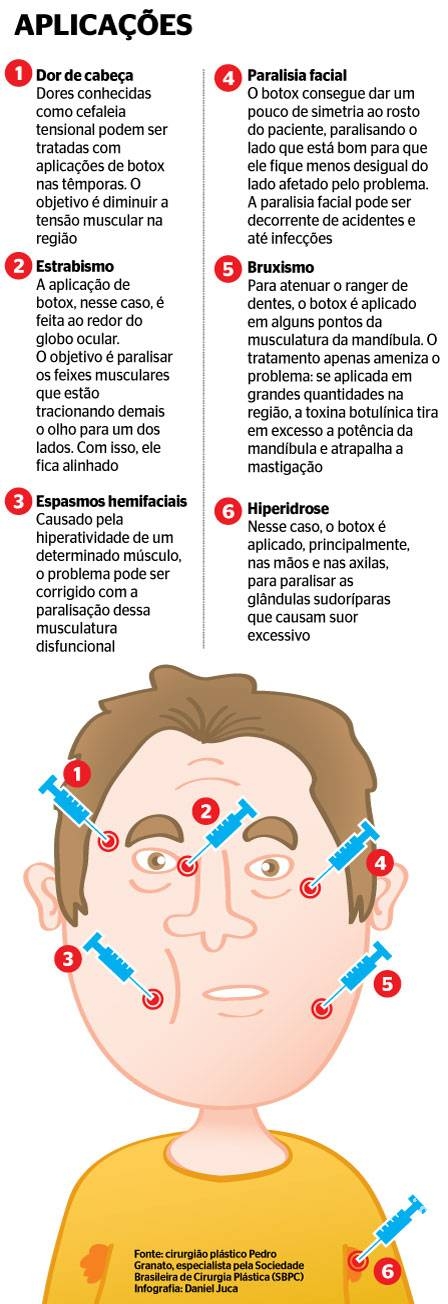 Botox também serve para tratar dores de cabeça, paralisia facial e bruxismo