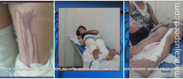 Jovem é queimada com ácido em trote 