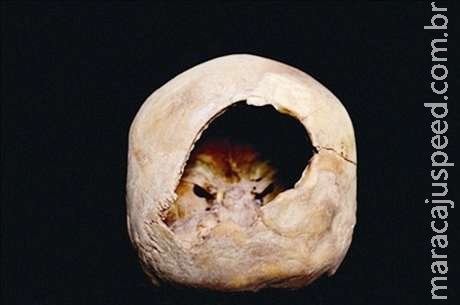  Arqueólogos encontram múmia que passou por cirurgia cerebral