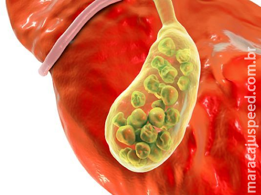 Pedra na vesícula: cálculos que causam dor na região abdominal