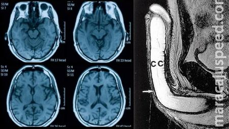 Covid afeta pênis, testículos e reduz tamanho do cérebro, dizem estudos