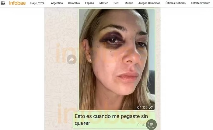 Ex-primeira-dama da Argentina mostra hematomas após agressões