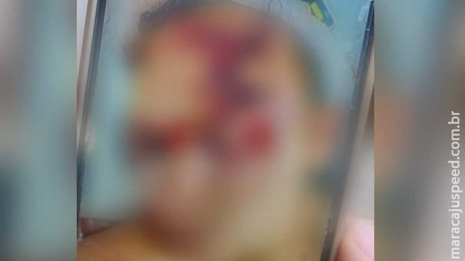 Jovem é espancado em confraternização e fica com rosto desfigurado em Sidrolândia