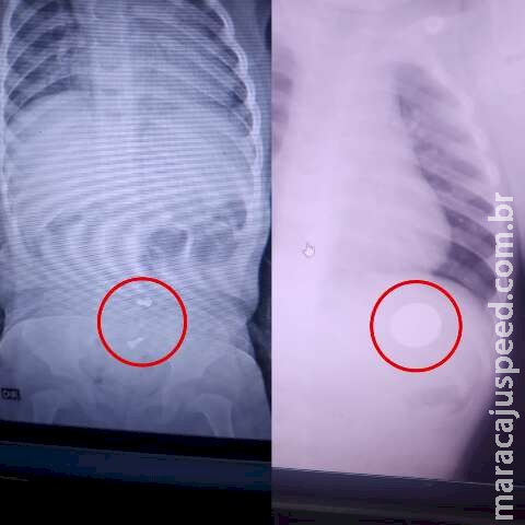 Diagnosticado com pneumonia, bebê tinha moeda e parafusos no estômago